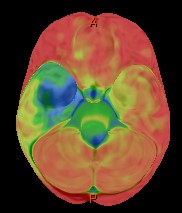 IRM 3D fuzionat cu PET/CT FDG Scleroză temporală mezială (MTS) pe partea dreaptă
