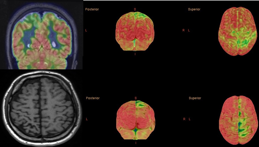 IRM coronal fuzionat cu PET-CT FDG, reconstrucție 3D, T1 axial