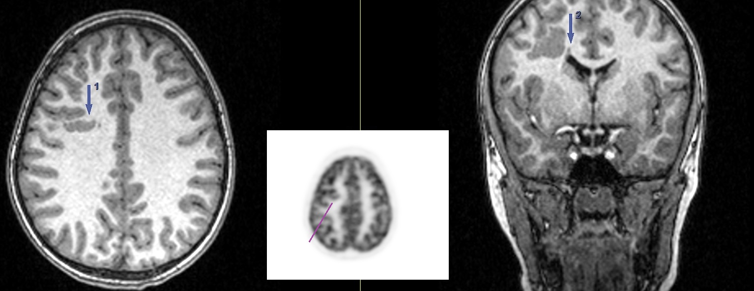 IRM axial și coronal T1; proiecție MIP din studiul PET-CT cu FDG