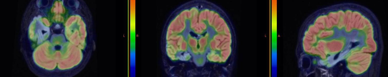 Studii IRM fuzionat cu PET-CT FDG