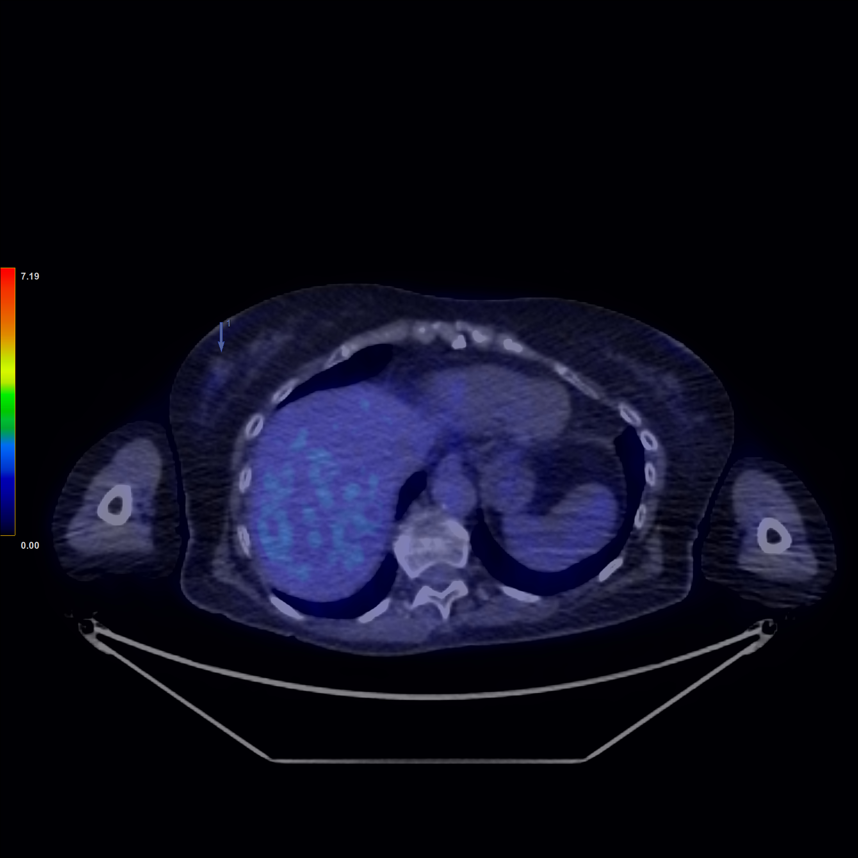 Fig 3 Carcinom mamar lobular Fig. 3: Carcinom mamar lobular