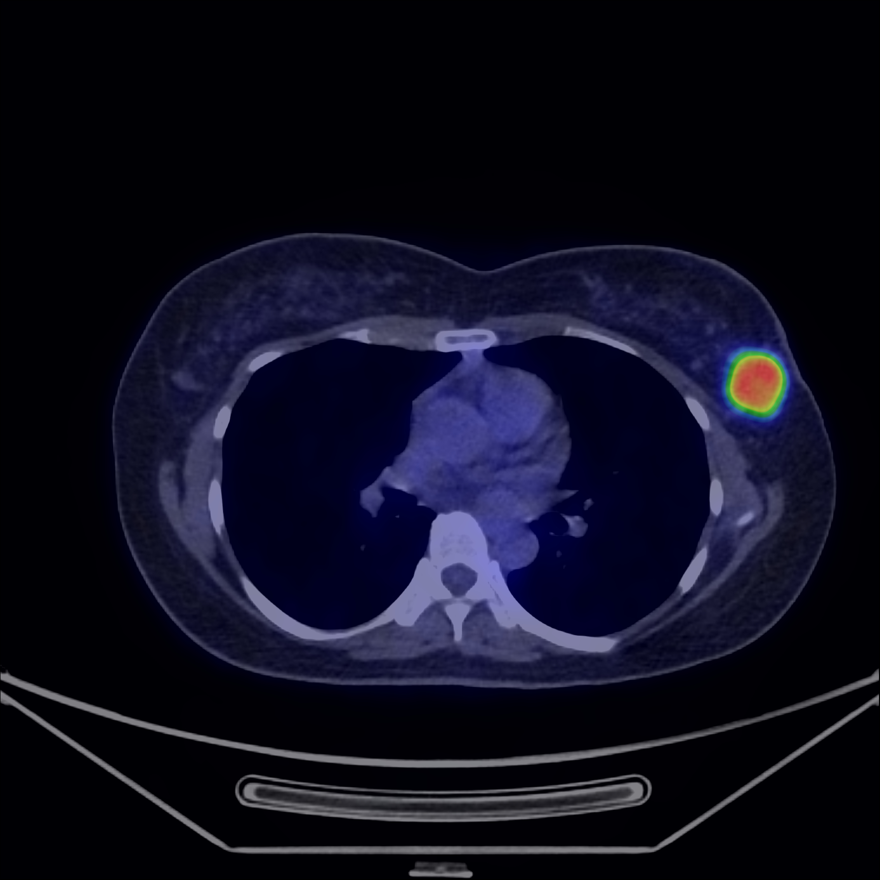 Fig 4 Carcinom mamar de tip NOS Fig. 4 Carcinom mamar de tip NOS