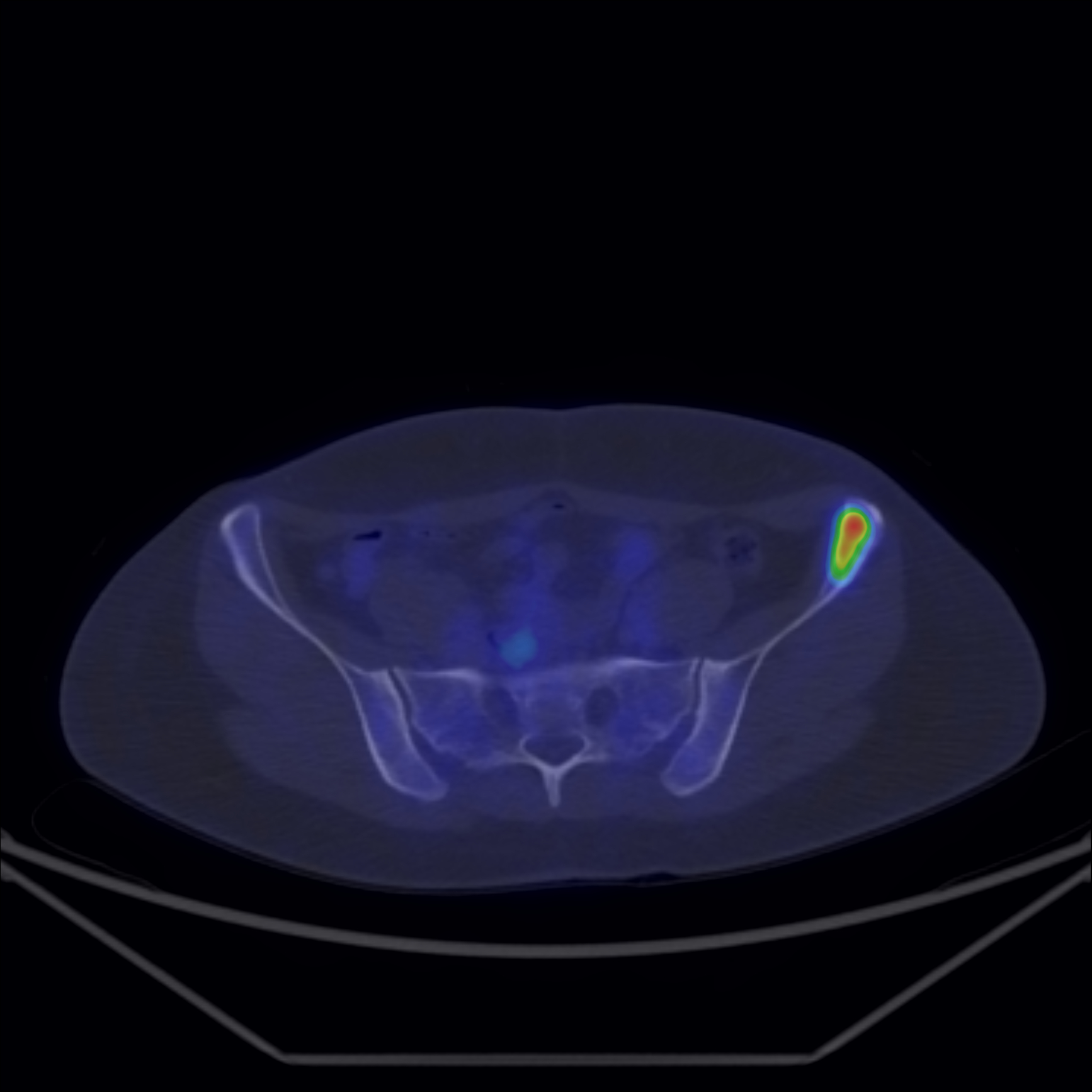 Fig 6 Determinare secundara osoasa captanta FDG Fig. 6: Determinare secundara osoasa captanta FDG
