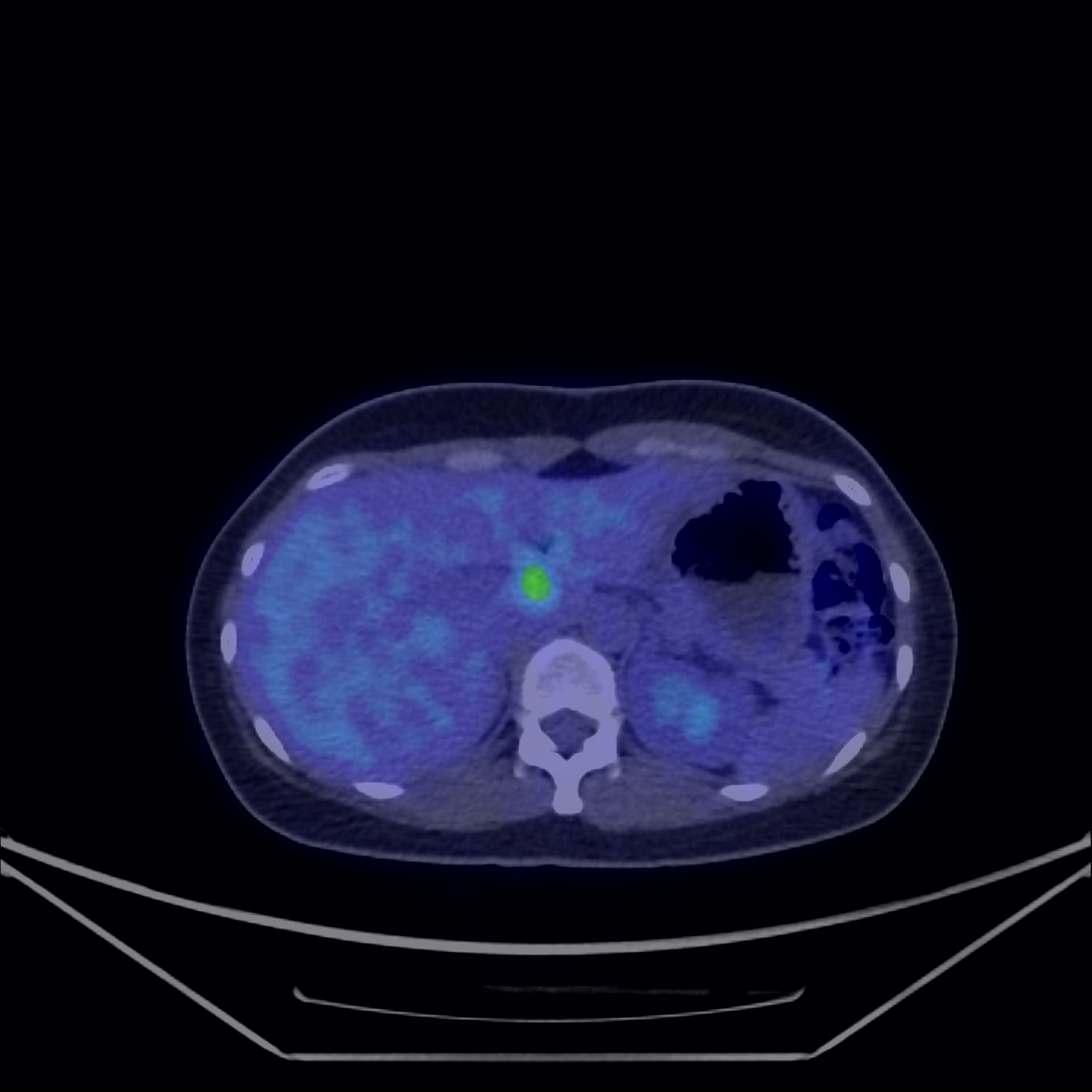 Fig 7 Determinare secundara hepatica F ig. 7: Determinare secundara hepatica