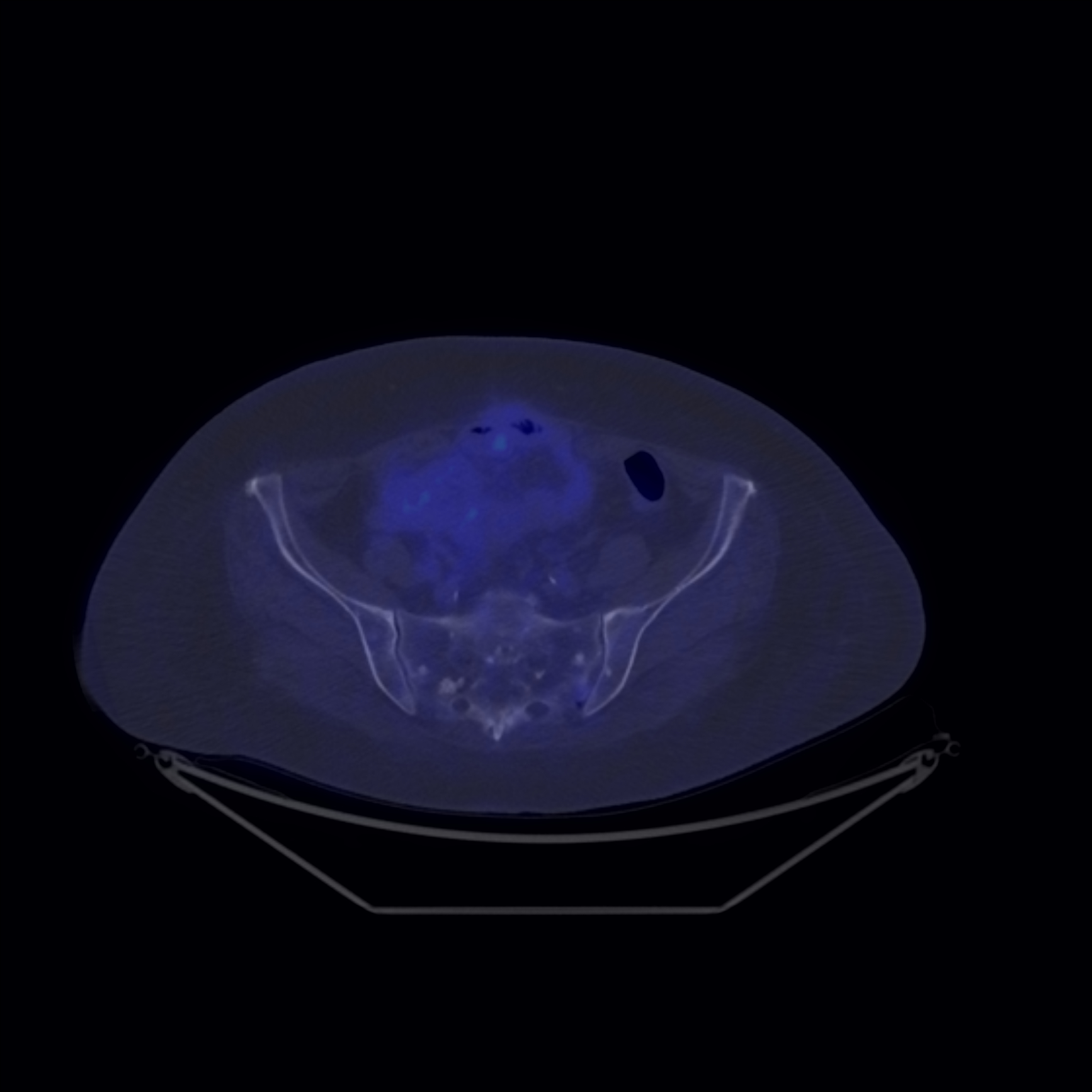 Fig 8 Determinari secundare osteosclerotice necaptante FDG