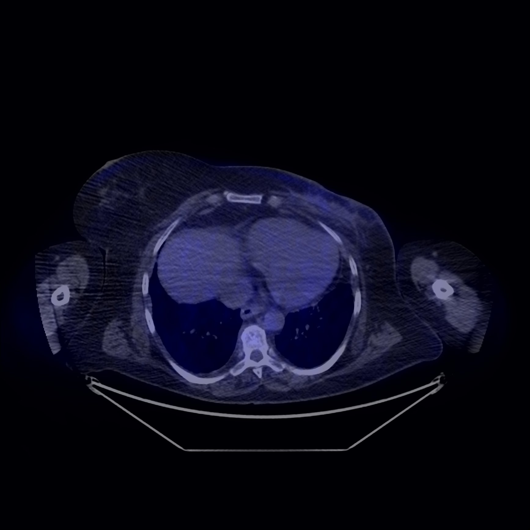 Fig 9 Modificari fibrotice post chirurgicale